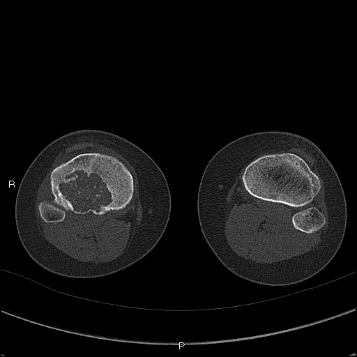 Chondroblastoma (Radiopaedia 62721-71030 Axial bone window 66).jpg