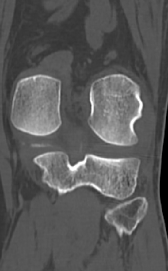 Chondrocalcinosis (Radiopaedia 82862-97173 Coronal bone window 57).jpg
