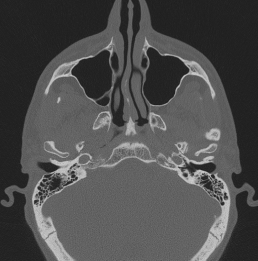 Chondrosarcoma (clivus) (Radiopaedia 46895-51425 Axial bone window 55).png