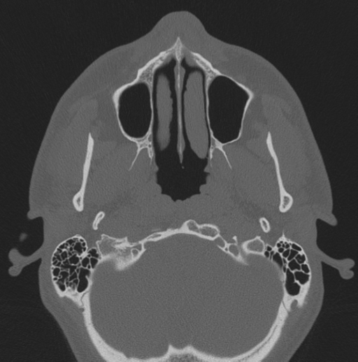 Chondrosarcoma (clivus) (Radiopaedia 46895-51425 Axial bone window 69).png