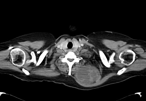 File:Chondrosarcoma - chest wall (Radiopaedia 65192-74199 C 3).jpg