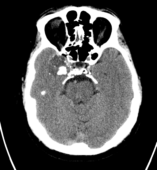 File:Chondrosarcoma of skull base- grade II (Radiopaedia 40948-43653 Axial non-contrast 10).png