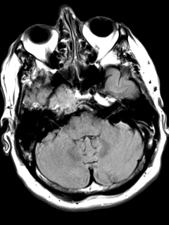 File:Chondrosarcoma of skull base- grade II (Radiopaedia 40948-43654 Axial T2 FLAIR 5).png