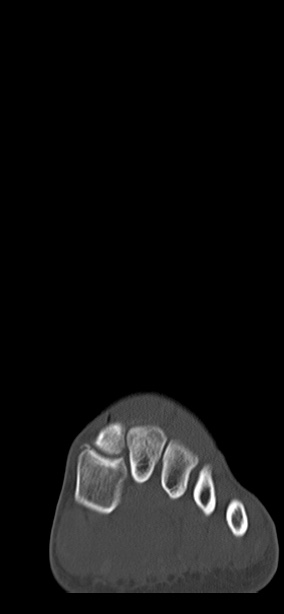 Chopart fracture (Radiopaedia 35347-36851 Coronal bone window 60).jpg