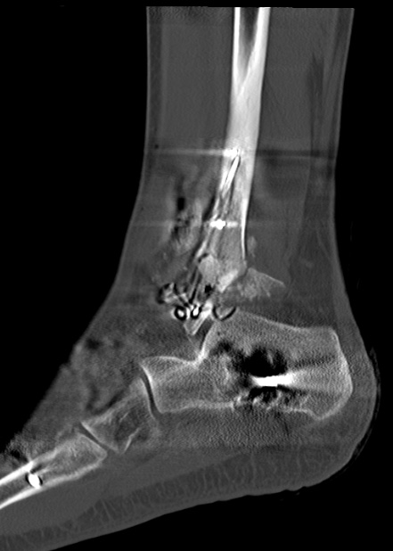 Chopart fracture (Radiopaedia 35347-36861 Sagittal bone window 53).jpg