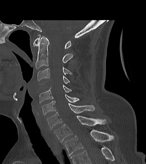 File:Chordoma (C4 vertebra) (Radiopaedia 47561-52188 Sagittal bone window 40).png