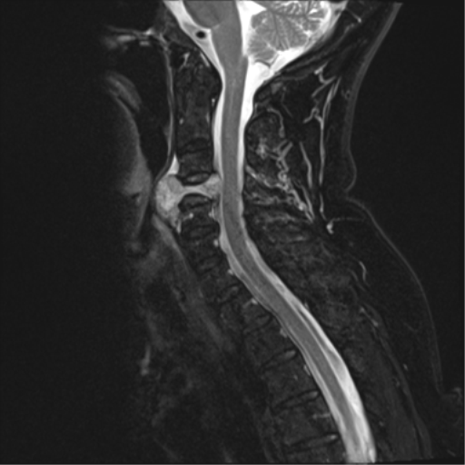 File:Chordoma (C4 vertebra) (Radiopaedia 47561-52189 Sagittal T2 fat sat 7).png