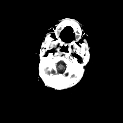Choroid plexus papilloma (Radiopaedia 63946-72698 Axial with contrast 3).jpg