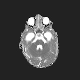 File:Choroid plexus papilloma (Radiopaedia 84612-100019 Axial ADC 8).jpg