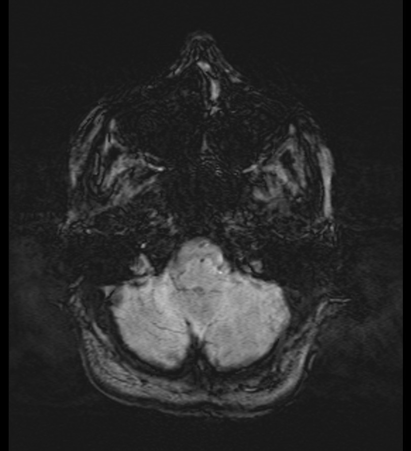 Choroid plexus xanthogranuloma (Radiopaedia 91271-108875 Axial SWI 12).jpg