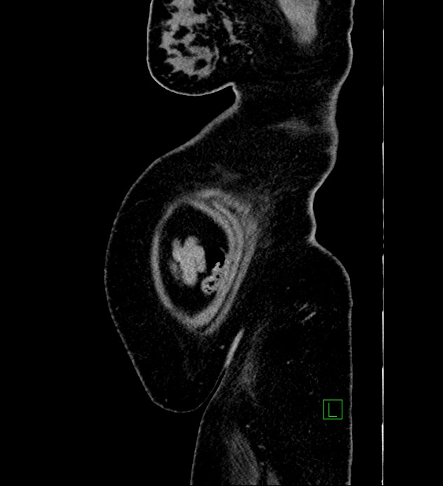 Chromophobe renal cell carcinoma (Radiopaedia 84239-99519 G 6).jpg