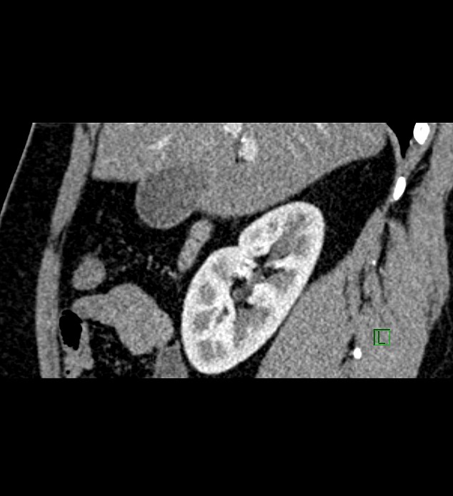 Chromophobe renal cell carcinoma (Radiopaedia 84286-99573 F 118).jpg