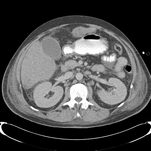 Chronic diverticulitis complicated by hepatic abscess and portal vein thrombosis (Radiopaedia 30301-30938 A 40).jpg