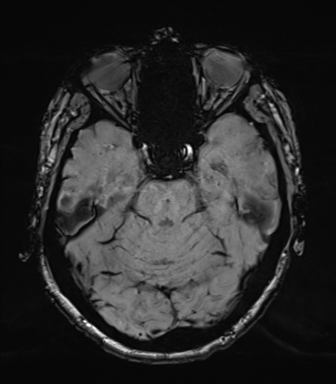 Chronic hypertensive encephalopathy (Radiopaedia 39993-42482 Axial SWI 28).png