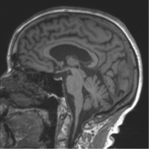 Chronic hypertensive encephalopathy (Radiopaedia 39993-42482 Sagittal T1 46).png