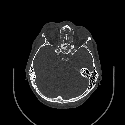 Chronic invasive fungal sinusitis (Radiopaedia 50342-55710 Axial bone window 89).jpg