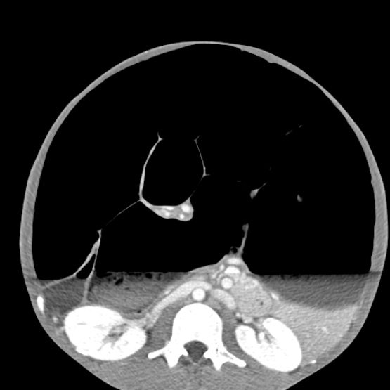 File:Chronic large bowel pseudo-obstruction (Radiopaedia 43181-46492 A 87).jpg