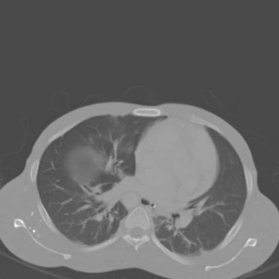 Chronic large bowel pseudo-obstruction (Radiopaedia 43181-46492 Axial bone window 14).jpg