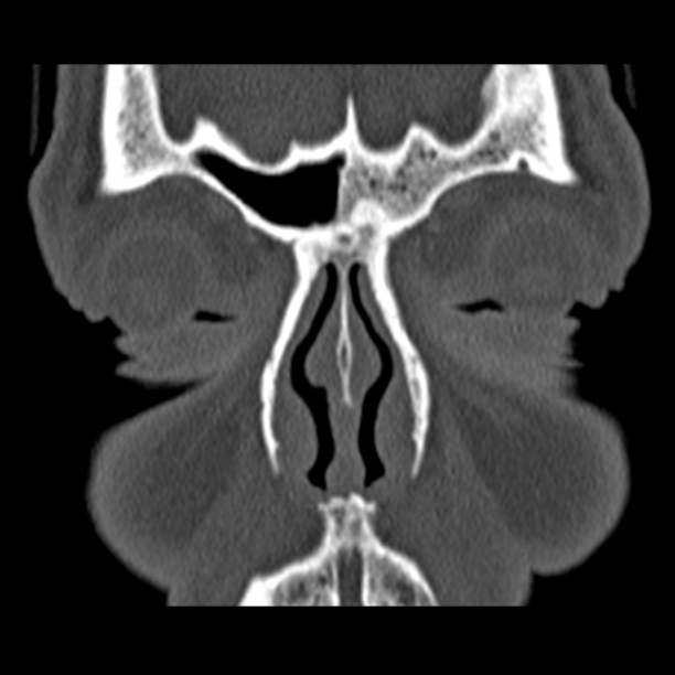 Chronic maxillary sinusitis (Radiopaedia 27879-28116 Coronal bone window 10).jpg