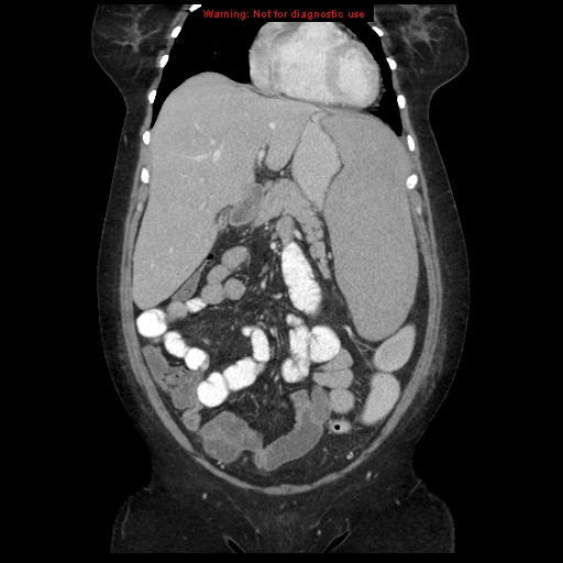 File:Chronic myeloid leukemia with splenic infarction (Radiopaedia 9178-9874 E 15).jpg