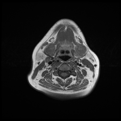 File:Chronic submandibular sialadenitis (Radiopaedia 61852-69885 Axial T1 16).jpg