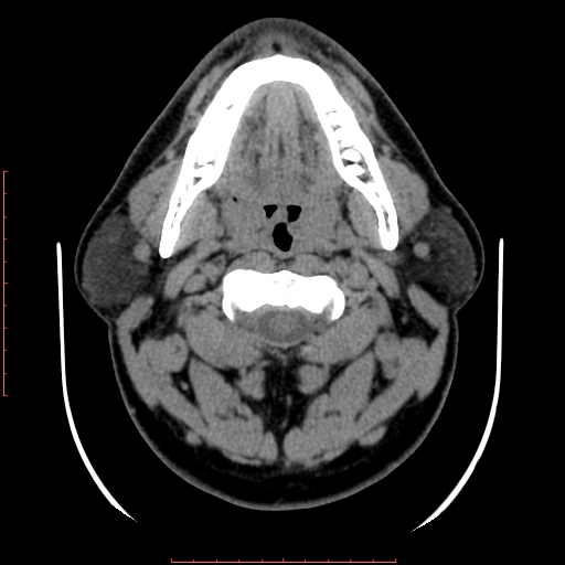 Chronic submandibular sialolithiasis (Radiopaedia 69817-79814 Axial non-contrast 81).jpg