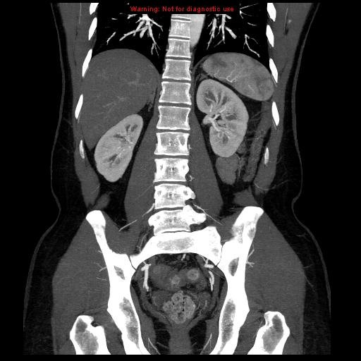 File:Circumaortic left renal vein (Radiopaedia 9069-9792 B 28).jpg