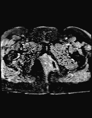 File:Class II Mullerian duct anomaly- unicornuate uterus with rudimentary horn and non-communicating cavity (Radiopaedia 39441-41755 Axial ADC 27).jpg