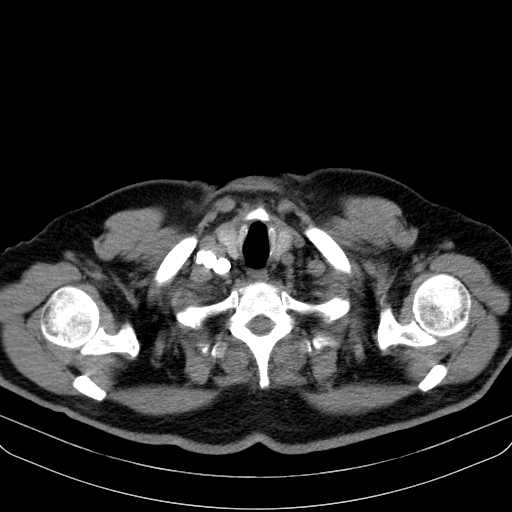 File:Classic complicated silicosis (Radiopaedia 49720-54961 Axial liver window 2).jpg