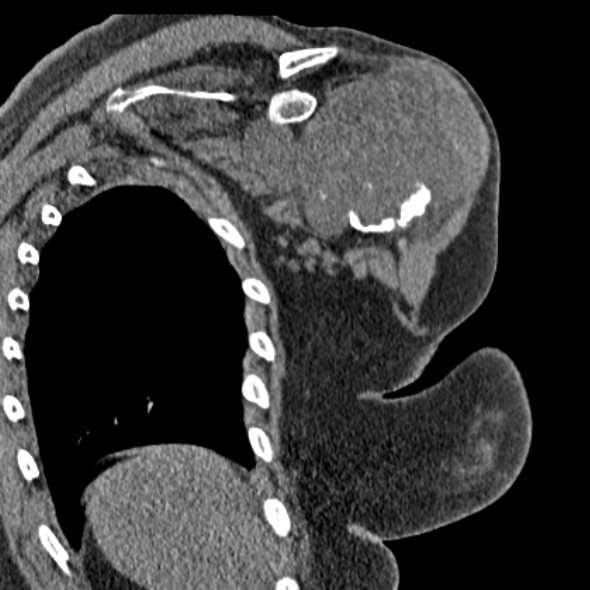 Clear cell chondrosarcoma - humerus (Radiopaedia 63104-71612 Coronal non-contrast 37).jpg