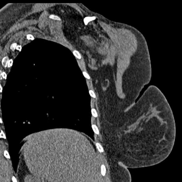 Clear cell chondrosarcoma - humerus (Radiopaedia 63104-71612 Coronal non-contrast 46).jpg