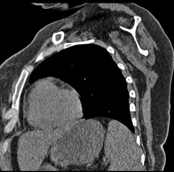 Clear cell chondrosarcoma - humerus (Radiopaedia 63104-71612 D 48).jpg