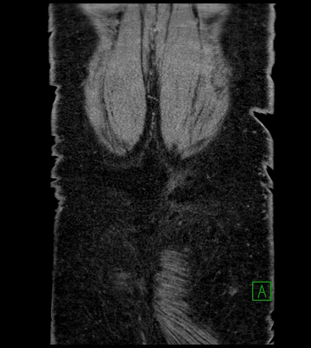 Closed-loop small bowel obstruction-internal hernia (Radiopaedia 78439-91096 Coronal non-contrast 96).jpg