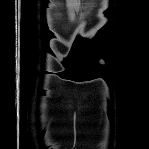 Closed loop obstruction due to adhesive band, resulting in small bowel ischemia and resection (Radiopaedia 83835-99023 E 125).jpg