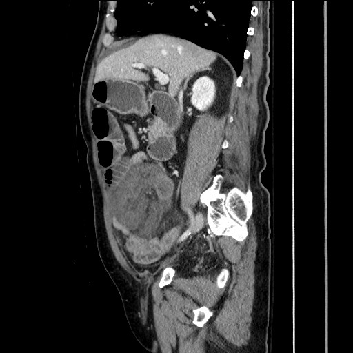 Closed loop obstruction due to adhesive band, resulting in small bowel ischemia and resection (Radiopaedia 83835-99023 F 76).jpg