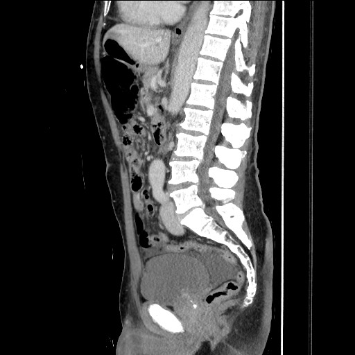 Closed loop small bowel obstruction - omental adhesion causing "internal hernia" (Radiopaedia 85129-100682 C 95).jpg