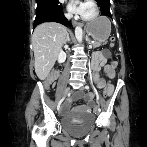 File:Closed loop small bowel obstruction due to adhesive band, with intramural hemorrhage and ischemia (Radiopaedia 83831-99017 C 67).jpg