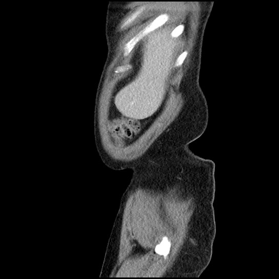 Closed loop small bowel obstruction due to adhesive band - U-shaped loop (Radiopaedia 83829-99012 C 65).jpg