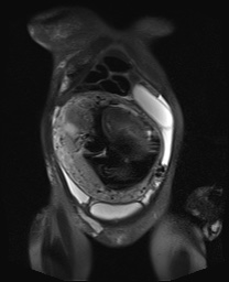 File:Closed loop small bowel obstruction in pregnancy (MRI) (Radiopaedia 87637-104031 Coronal T2 fat sat 16).jpg