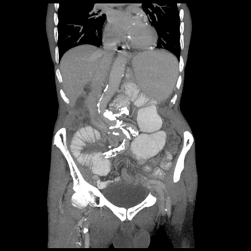 File:Closed loop small intestinal obstruction (Radiopaedia 16156-15835 Coronal non-contrast 4).png