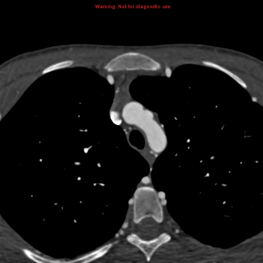 File:Coarctation of the aorta (Radiopaedia 12461-12697 A 36).jpg
