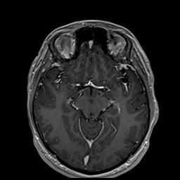 Cochlear incomplete partition type III associated with hypothalamic hamartoma (Radiopaedia 88756-105498 Axial T1 C+ 90).jpg