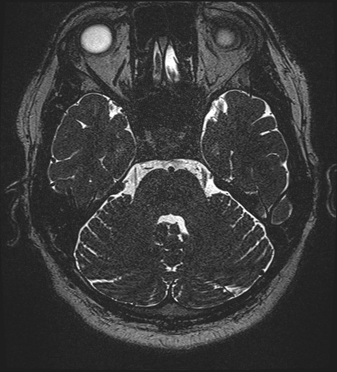 Cochlear incomplete partition type III associated with hypothalamic hamartoma (Radiopaedia 88756-105498 Axial T2 101).jpg