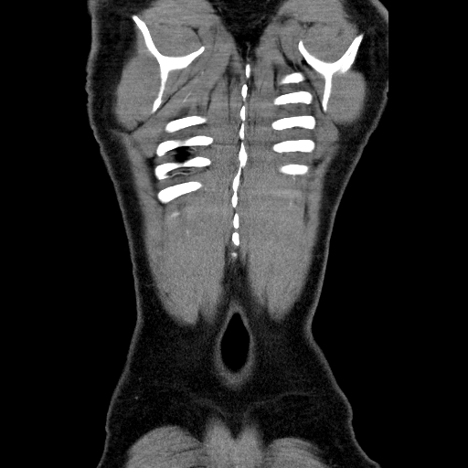 File:Codominant double aortic arch (Radiopaedia 56012-62637 B 46).jpg