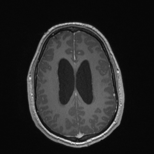File:Colloid cyst (Radiopaedia 44510-48181 Axial T1 C+ 127).png