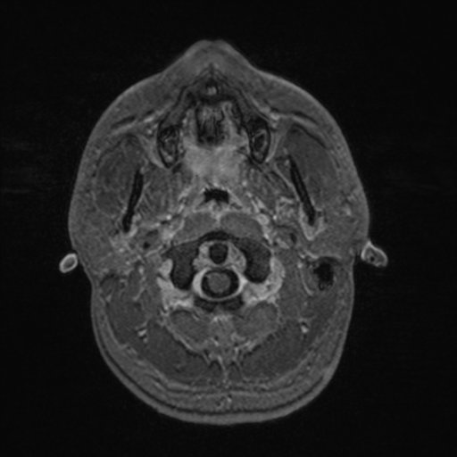 Colloid cyst (Radiopaedia 44510-48181 Axial T1 C+ 18).png
