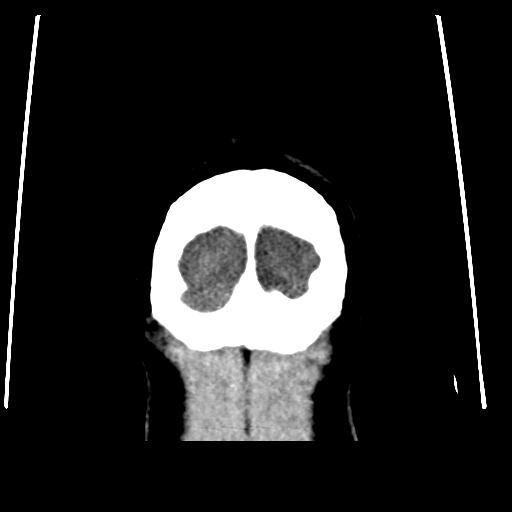 Colloid cyst (resulting in death) (Radiopaedia 33423-34469 Coronal non-contrast 53).png