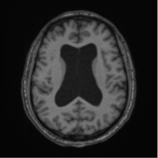 File:Colloid cyst of the third ventricle (Radiopaedia 86571-102662 Axial T1 47).png