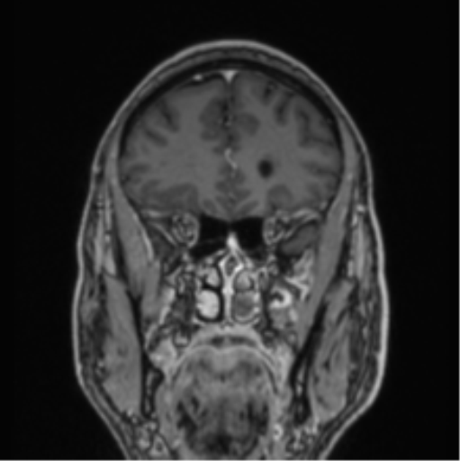 File:Colloid cyst of the third ventricle (Radiopaedia 86571-102662 Coronal T1 C+ 69).png