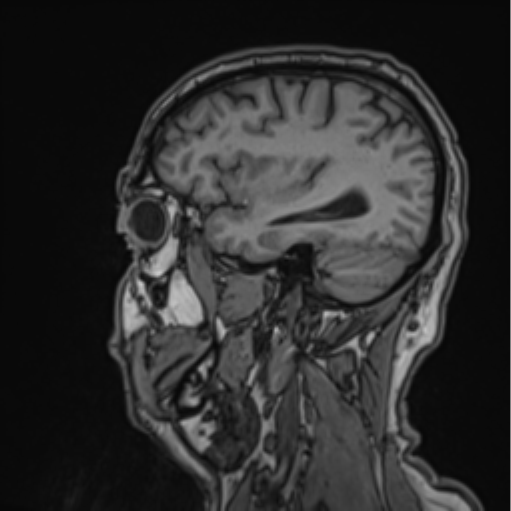 File:Colloid cyst of the third ventricle (Radiopaedia 86571-102662 Sagittal T1 58).png